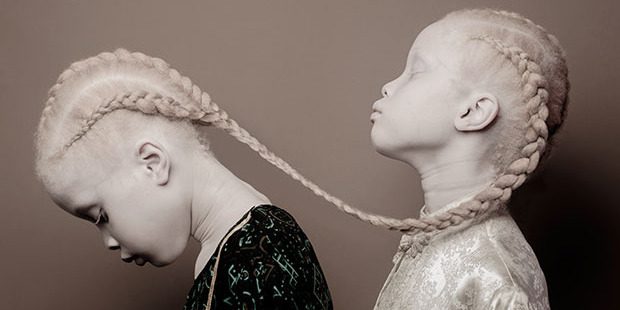 «Мы считаем, что это красиво». 11-летние сестры-альбиносы поразили весь мир