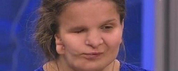 17-летняя Катя Бадаева с дефектом лица скончалась во время пластической операции