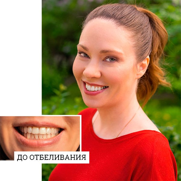 «Домашний Очаг» тестирует отбеливание зубов: это работает?
